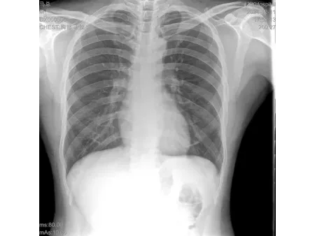 Caméra à rayons X numérique portable ANGEL/Radiographie portable ou mobile ANGEL