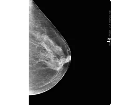 Système de mammographie numérique/Appareil de mammographie