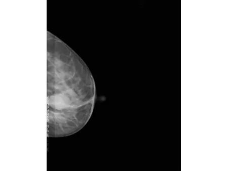 Système de mammographie numérique/Appareil de mammographie