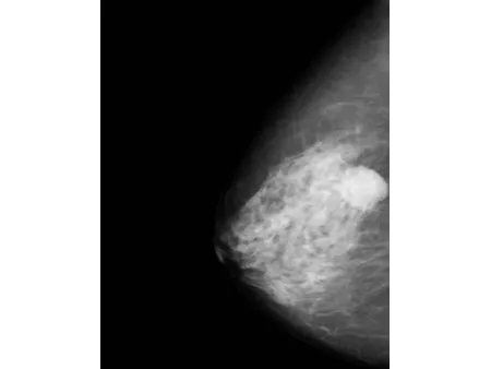 Système de mammographie numérique/Appareil de mammographie
