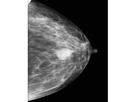 Système de mammographie numérique/Appareil de mammographie